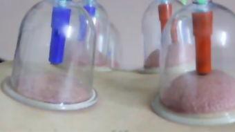 拔火罐视频教程,视频教程详解