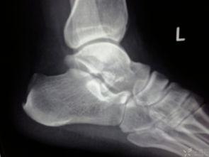 距骨骨折康复训练视频