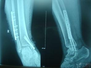 距骨骨折康复训练视频